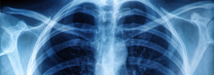 Chiropractic Pleasanton CA Why We Use Xray